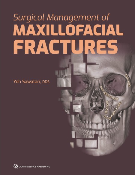 Surgical Management of Maxillofacial Fractures 1st Edition
