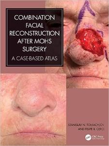 Combination Facial Reconstruction after Mohs Surgery A Case Based Atlas