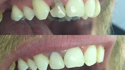 Dental Composites - A Cosmetic Tooth Filling