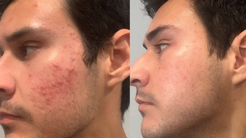 How To Get Rid Of Acne Fast And For Good