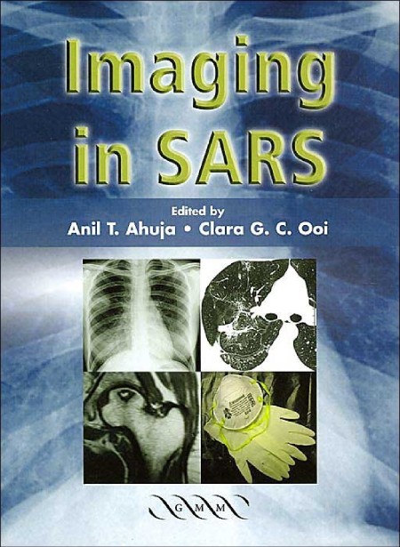 Imaging in SARS by A. T. Ahuja