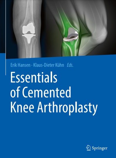 Essentials of Cemented Knee Arthroplasty (2024)