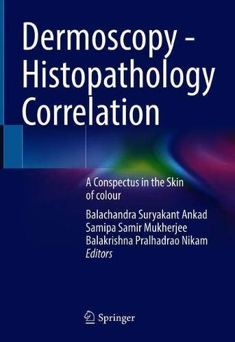 Dermoscopy – Histopathology Correlation A Conspectus in the Skin of colour (2024)