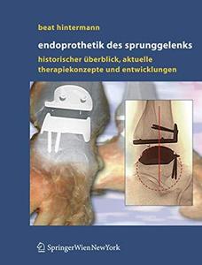 Endoprothetik des Sprunggelenks Historischer Überblick, aktuelle Therapiekonzepte und Entwicklungen