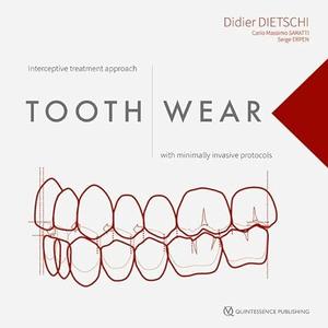 Tooth Wear Interceptive Treatment Approach With Minimally Invasive Protocols